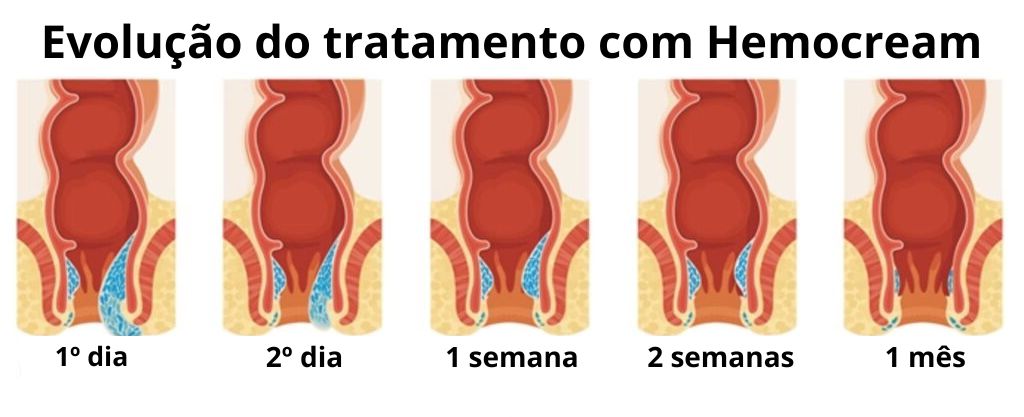Tratamento Hemocream